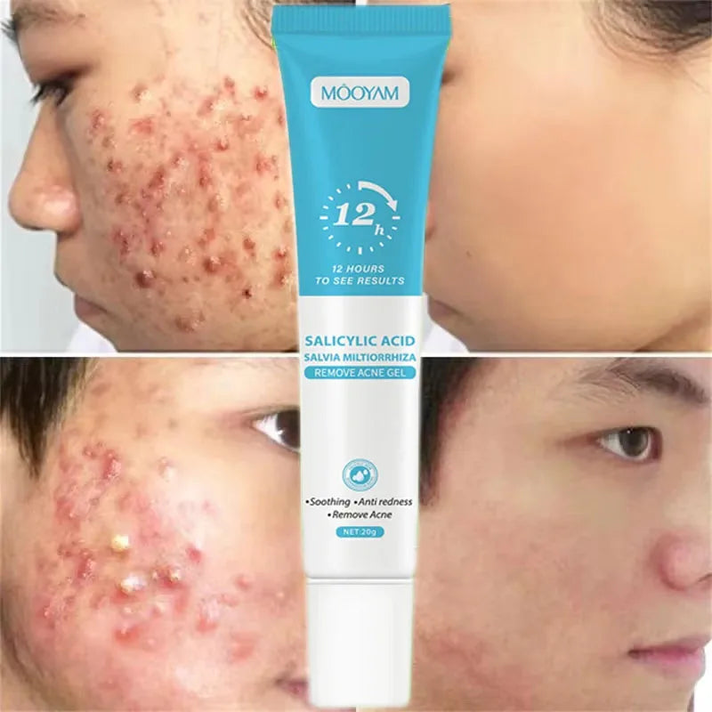 Acne Cream Face Pimples Remover