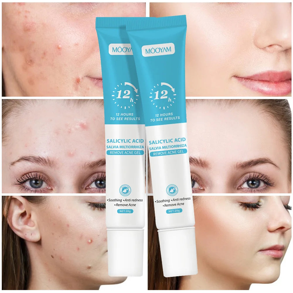 Acne Cream Face Pimples Remover