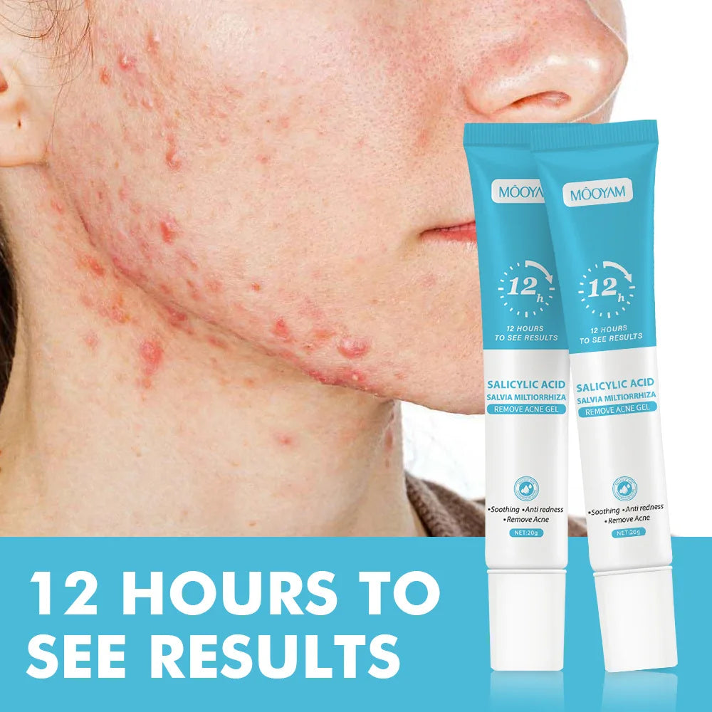 Acne Cream Face Pimples Remover
