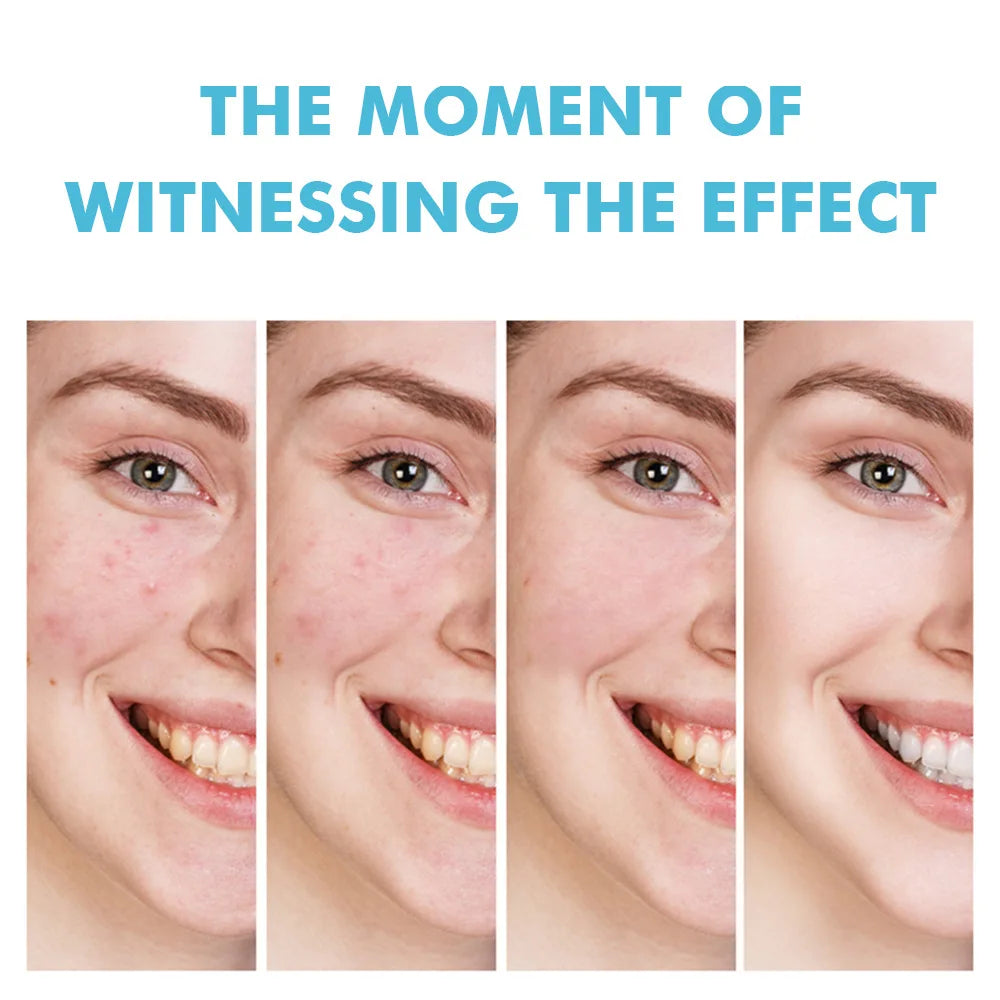 Acne Cream Face Pimples Remover